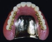金属床義歯（自費）
